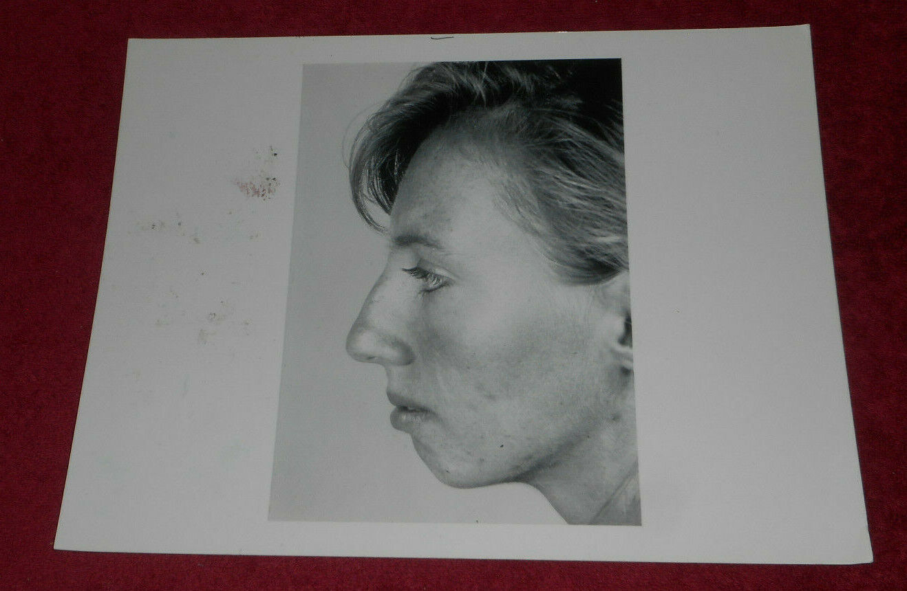 1993 Press Photo Unidentified Plastic Surgery Patient Face Profile