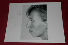 1993 Press Photo Unidentified Plastic Surgery Patient Face Profile picture