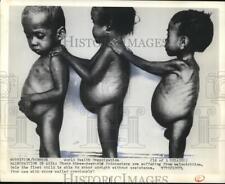 1974 Press Photo Three-year-old Indonesians are suffering from malnutrition picture