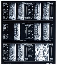 Original Hospital MRI Scan Lumbar Spine Lower Back Vertebrae Medical Film Vtg picture