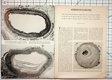 Vintage ATHEROSCLEROSIS Medical Article Pages Circulatory System Ephemera picture
