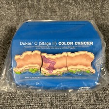 Colon Cancer Anatomical Anatomy Model Chart Display Roche Pharmaceutical Xeloda picture