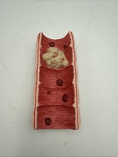 Vintage Colon Cancer Digestive Pathology Anatomical Model picture